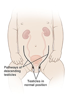 undescended testes